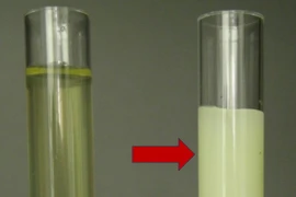 Nước tiểu trắng như sữa, người bệnh có thể chết do xơ gan, lao phổi...