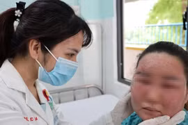 Lột trắng da tại nhà cô gái 28 tuổi bị dị ứng bội nhiễm hỏng mặt