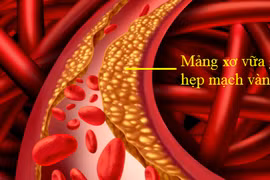 Bác sĩ mách cách giảm nguy cơ hẹp mạch máu não, phòng đột quỵ