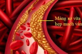 Bác sĩ mách cách giảm nguy cơ hẹp mạch máu não, phòng đột quỵ