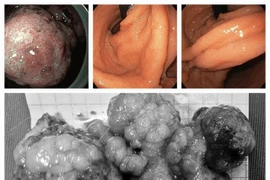 Cắt tách niêm mạc qua nội soi lấy polyp lớn dạ dày ung thư hóa