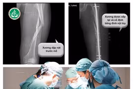 Cây đổ đè trúng người, nam thanh niên bị dập nát xương đùi trái