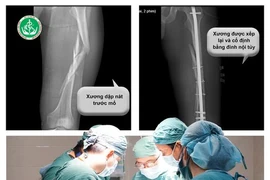 Cây đổ đè trúng người, nam thanh niên bị dập nát xương đùi trái