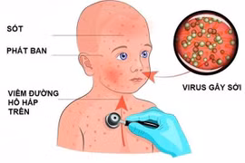 Bệnh sởi - những điều bố mẹ cần biết để phòng trong mùa dịch