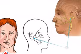 Trời rét lạnh: đang chơi bé gái 4 tuổi đột ngột liệt mặt