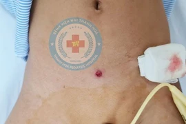 Trẻ 5 tuổi bị đạn súng cao su bắn thủng 5 lỗ ruột non