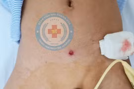 Trẻ 5 tuổi bị đạn súng cao su bắn thủng 5 lỗ ruột non