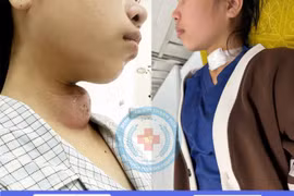 Lấy khối áp xe cổ 14 năm do dị tật khe hở mang cho trẻ