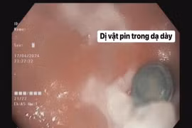 Bé 5 tuổi nuốt nhầm pin cúc: cẩn thận loét, hoại tử thủng đường tiêu hóa