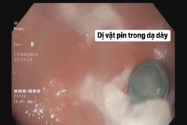 Bé 5 tuổi nuốt nhầm pin cúc: cẩn thận loét, hoại tử thủng đường tiêu hóa