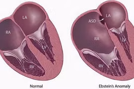 Mang thai đã sàng lọc, sau sinh trẻ tím tái vì dị tật tim bẩm sinh
