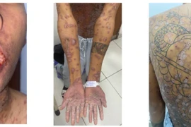 Điều trị thành công ca bệnh da đặc biệt hiếm gặp thứ 10 trên thế giới