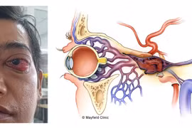 Điều trị thành công cho bệnh nhân bị lồi mắt sau tai nạn