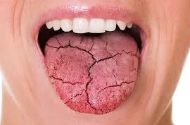 Bài thuốc độc đáo chữa chứng khô miệng vào ban đêm