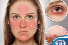 Đa dạng biến chứng trên cơ thể do Lupus ban đỏ nhiều người không biết