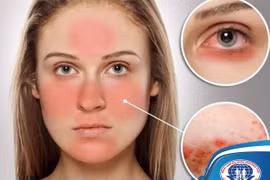 Đa dạng biến chứng trên cơ thể do Lupus ban đỏ nhiều người không biết