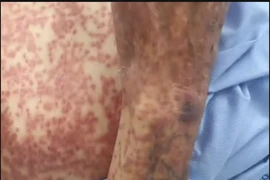 Sử dụng nhiều thuốc cụ già 78 tuổi suy giảm ý thức, nổi ban khắp người