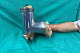 Bác sĩ "hồi sinh" bàn tay phải bị dập nát do máy xay thịt
