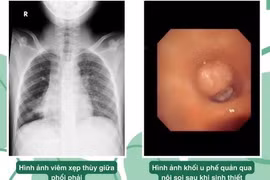 Ho kéo dài bé trai 10 tuổi phát hiện u ác phế quản phổi hiếm gặp