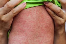 TPHCM: Ghi nhận 02 trường hợp mắc bệnh sởi trên trẻ chưa được tiêm vắc xin