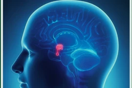 Cảnh báo đột quỵ tuyến yên ít người biết