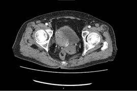 Tạo hình bàng quang bằng ruột non cứu bệnh nhân ung thư thoát khỏi án tử