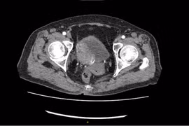 Tạo hình bàng quang bằng ruột non cứu bệnh nhân ung thư thoát khỏi án tử