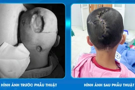 Hy hữu: Bé 7 tuổi hoại tử da đầu do nấm bội nhiễm, cách phòng tránh