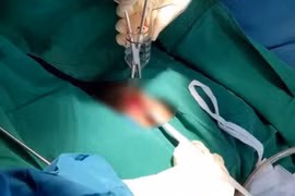  Thanh niên 23 tuổi bị dương vật giả dài hơn 20cm mắc kẹt trong trực tràng