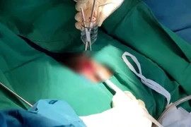  Thanh niên 23 tuổi bị dương vật giả dài hơn 20cm mắc kẹt trong trực tràng