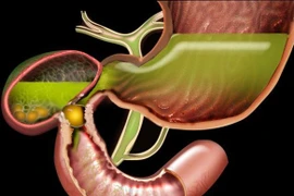 Chủ quan sỏi túi mật nhiều năm cụ ông 97 tuổi bị tắc ruột 