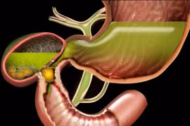 Chủ quan sỏi túi mật nhiều năm cụ ông 97 tuổi bị tắc ruột 