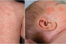 62 tỉnh thành có ca dương tính với sởi