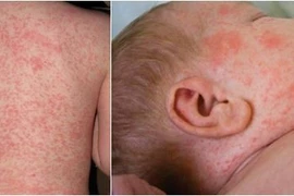 62 tỉnh thành có ca dương tính với sởi