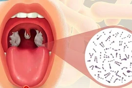 Phân biệt bệnh bạch hầu họng với các chứng viêm họng, amidan thông thường