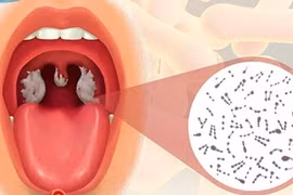 Phân biệt bệnh bạch hầu họng với các chứng viêm họng, amidan thông thường