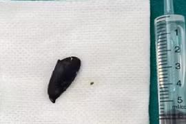 Ho, khó thở 3 tháng mới phát hiện mắc hạt hồng xiêm trong phế quản