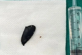 Ho, khó thở 3 tháng mới phát hiện mắc hạt hồng xiêm trong phế quản