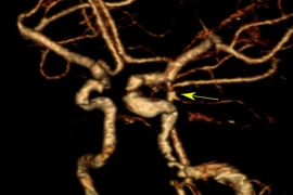 Đang nhặt rau đau đầu không ngờ vỡ túi phình mạch não phức tạp