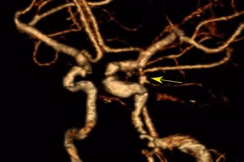 Đang nhặt rau đau đầu không ngờ vỡ túi phình mạch não phức tạp