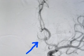 Phình mạch máu não – “Sát thủ thầm lặng” không thể coi thường