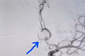 Phình mạch máu não – “Sát thủ thầm lặng” không thể coi thường