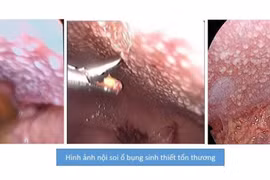 Đang khỏe mạnh tự nhiên chướng bụng không ngờ do lao màng bụng