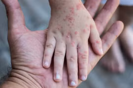 Hà Nội: Ca mắc rubella đầu tiên đã tiêm 2 mũi vắc xin phòng bệnh