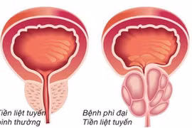 Bác sĩ mách cách phát hiện và điều trị thư tuyến tiền liệt đúng?