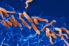 Khi nào vi khuẩn HP gây ung thư dạ dày?