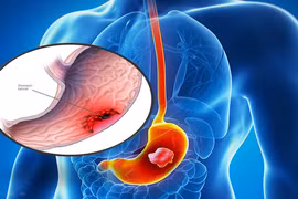 Biết con đường lây nhiễm HP và cách tránh mắc bệnh
