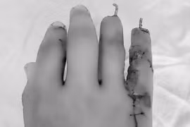 Bàn tay cháy đen vì nổ pháo tự chế