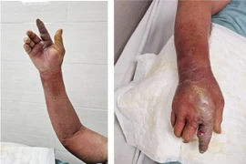 Chó cắn hoại tử cánh tay do viêm mô tế bào: