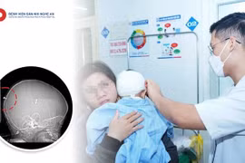 Ngã ngửa khi vui chơi, bé trai 23 tuổi bị đinh vít đâm vào đầu